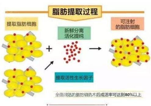 提取自体脂肪的过程