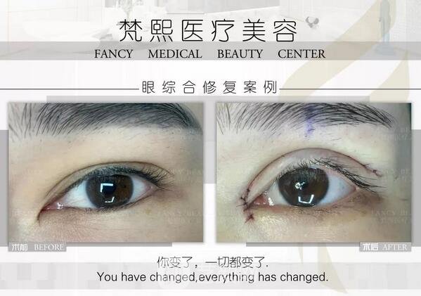 双眼皮修复