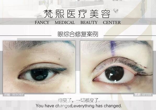 双眼皮修复案例图