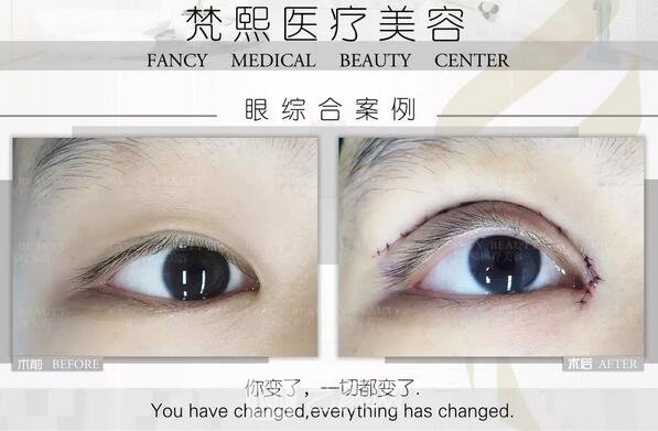 双眼皮整形案例