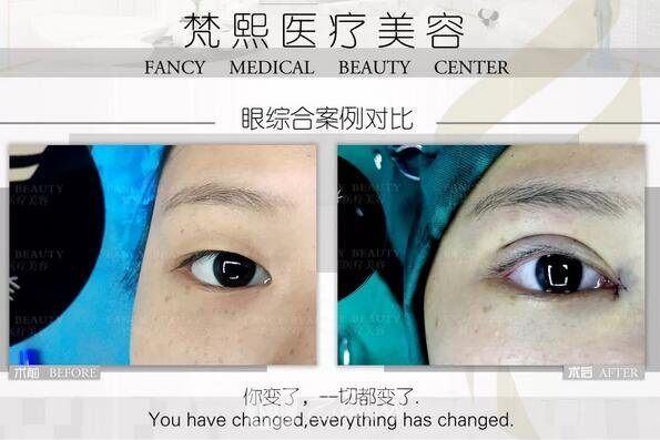 双眼皮整形案例