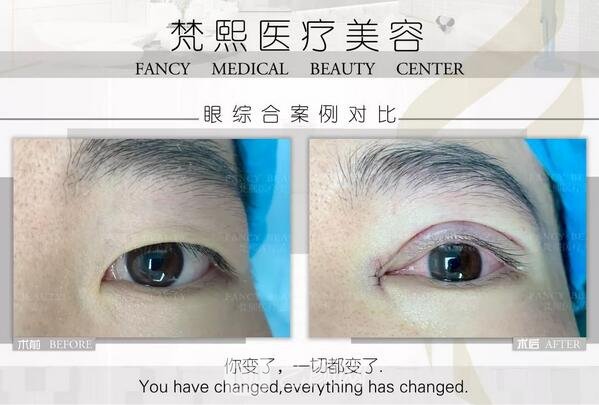 双眼皮整形案例果图