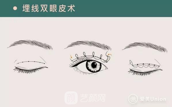埋线双眼皮手术