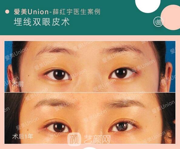 埋线双眼皮手术案例图