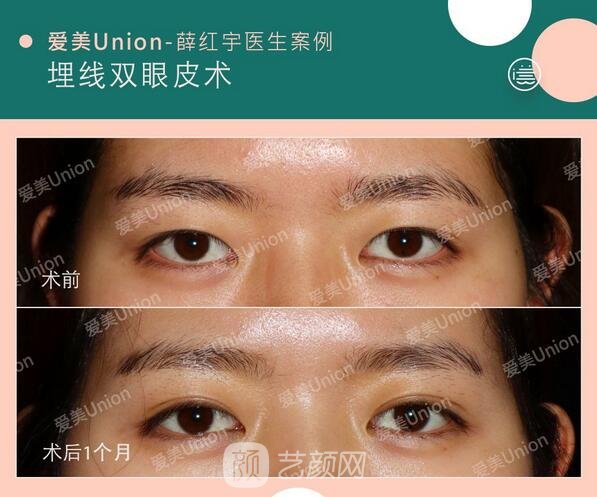 埋线双眼皮手术案例图