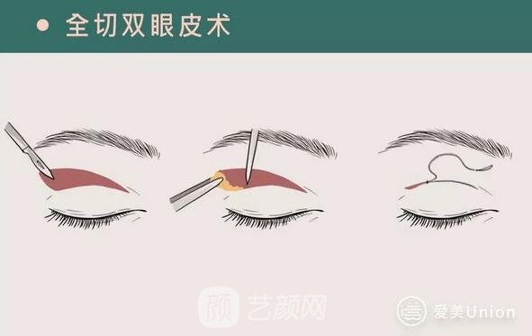 全切双眼皮手术