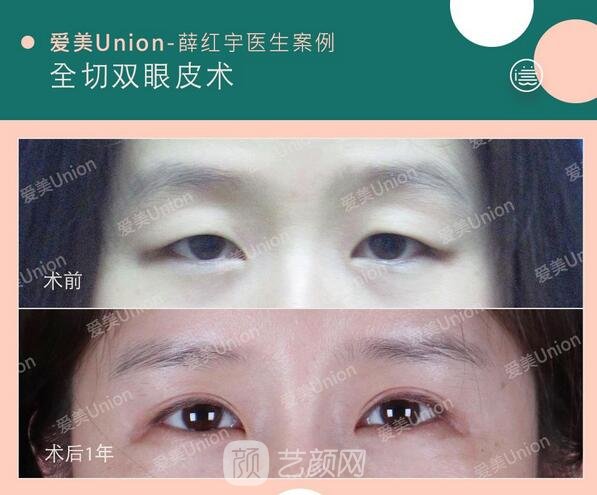 全切双眼皮手术果图