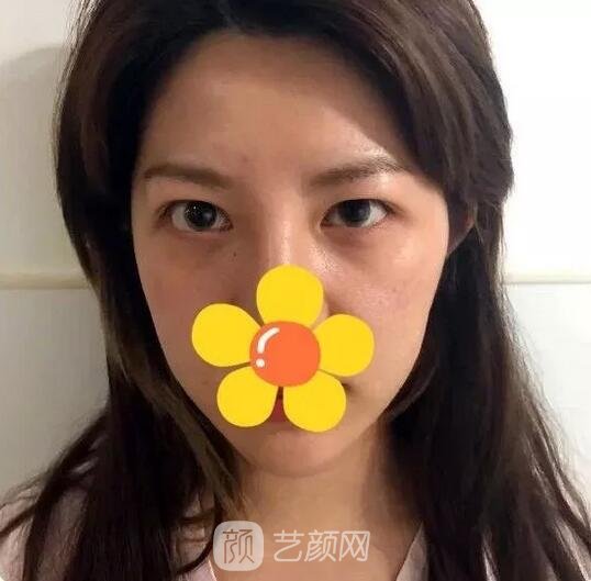 双眼皮手术术前额头扁平苹果肌凹陷内双