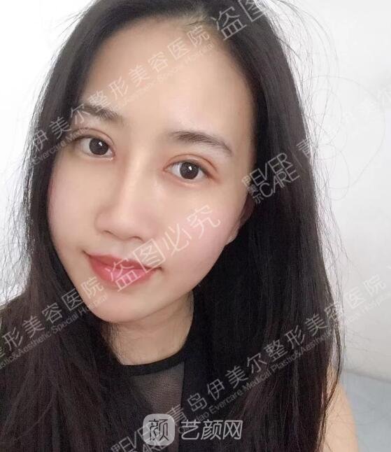 双眼皮术后7天果图