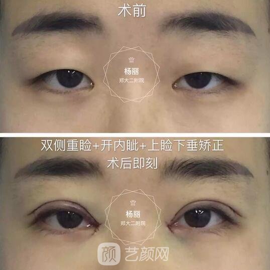 双侧重睑+内外眦开大+双侧上睑下垂矫正