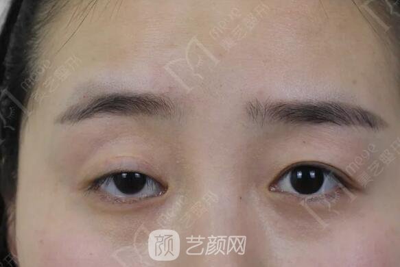 上睑下垂如果不重视双眼皮做了也白做！
