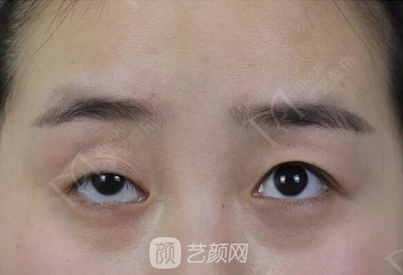 上睑下垂如果不重视双眼皮做了也白做！