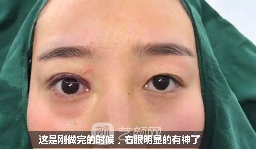 上睑下垂如果不重视双眼皮做了也白做！