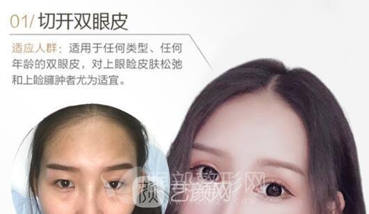 双眼皮手术怎么做