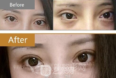 微创双眼皮果好不好