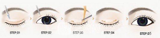 微创双眼皮手术原理