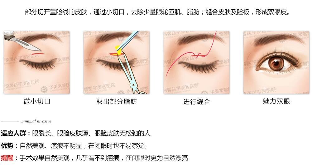 常说的微创双眼皮是不是就是韩式定点双眼皮呢？