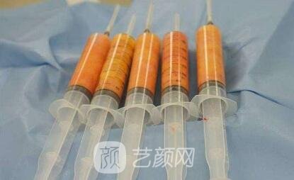 自体脂肪填充填充的价格多少呢?