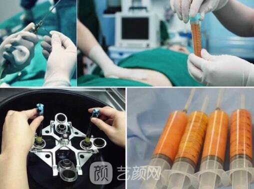 自体脂肪丰胸手术后的常见问题