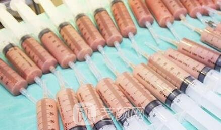 自体脂肪丰胸手术后的常见问题