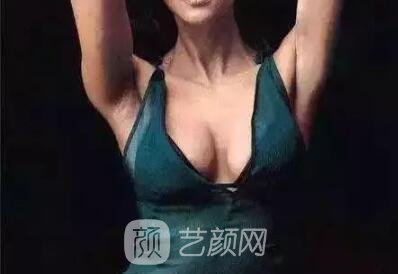 假体丰胸手术术后怎样护理?