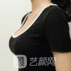 假体隆胸失败修复手术后怎样护理?