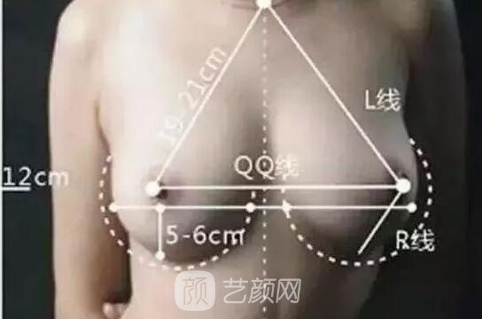 假体隆胸手感会很差吗?