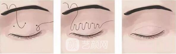 埋线双眼皮