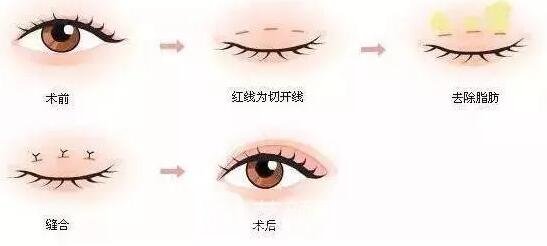 部分切开微创法双眼皮