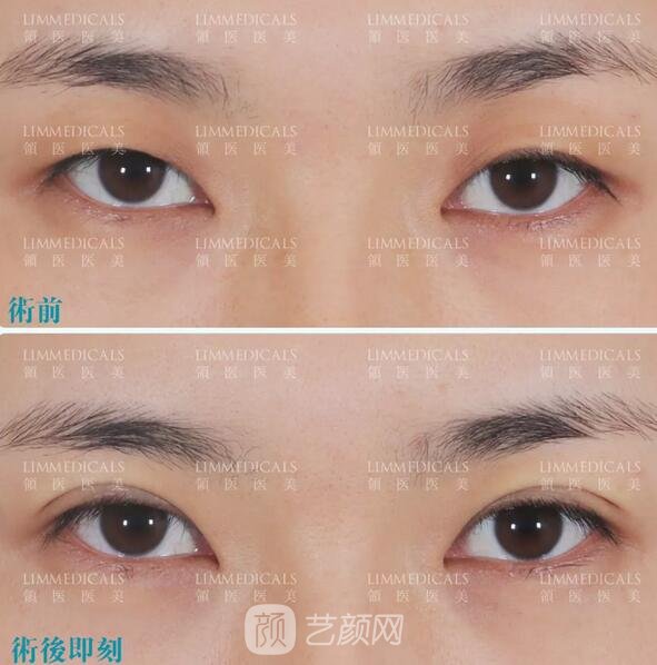 双眼皮案例图