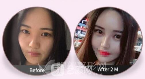 割双眼皮后多久可以化妆