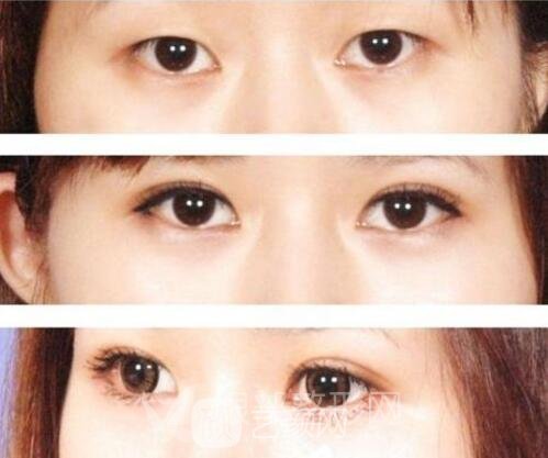 双眼皮埋线法果怎么样？