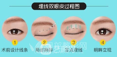 双眼皮埋线法好不好 你的眼型该如何选择术式