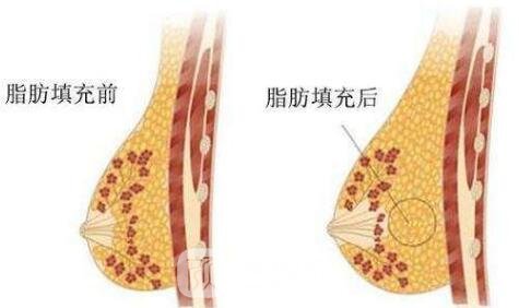 注射丰胸除开触感好还具有什么优点呢?