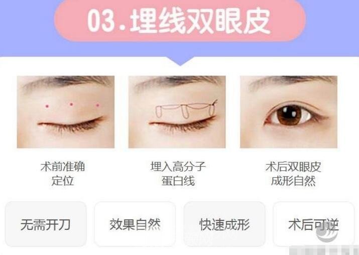 拉线双眼皮是埋线吗?