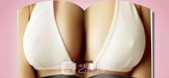 那些给隆胸扣的冤枉帽子!