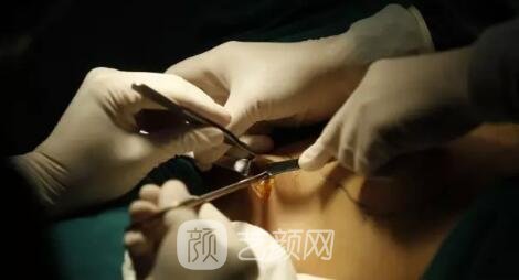 乳房的真相:隆胸的痛!