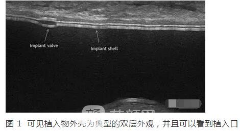 新视角：隆胸术后的新烦恼！