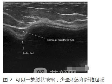 新视角：隆胸术后的新烦恼！