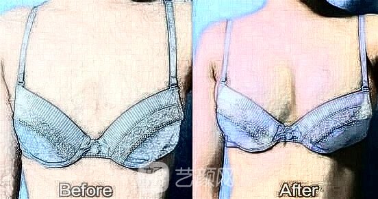 自体脂肪隆胸术有哪些禁忌?