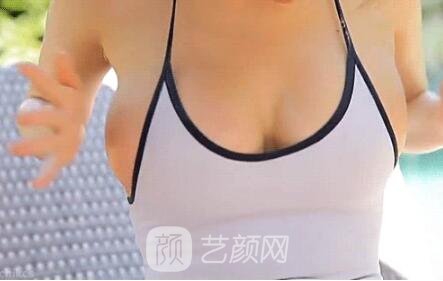 假体隆胸会痛疼吗?造成痛疼的缘故有什么?