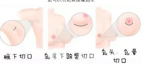 胸部敏感度会受隆胸手术的影响吗?