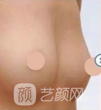 胸部敏感度会受隆胸手术的影响吗?