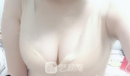 真实影响造成胸部下垂的要素是什么?