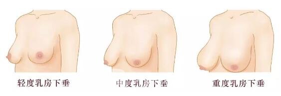 胸部下垂可分成哪几种呢?