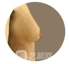 对于乳房下垂有什么纠正方式呢?
