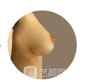 对于乳房下垂有什么纠正方式呢?