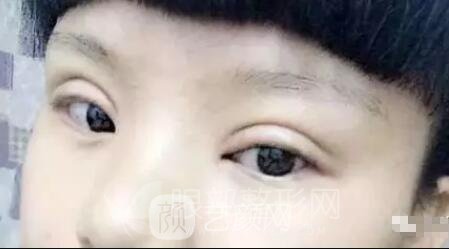 双眼皮手术失败