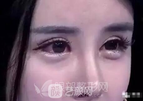 双眼皮失败 假深宽