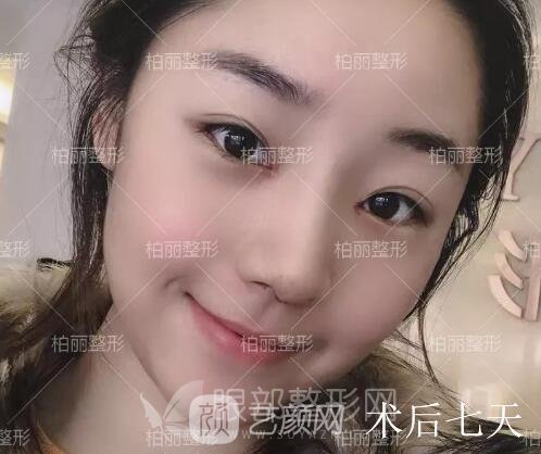 开眼角多久恢复 半个月够吗